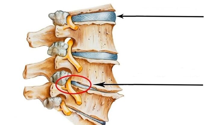 stuburo pažeidimas gimdos kaklelio osteochondrozės atveju