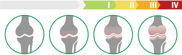 Klinikiniai kelio sąnario artrozės etapai (kelio sąnario artrozės laipsnis)