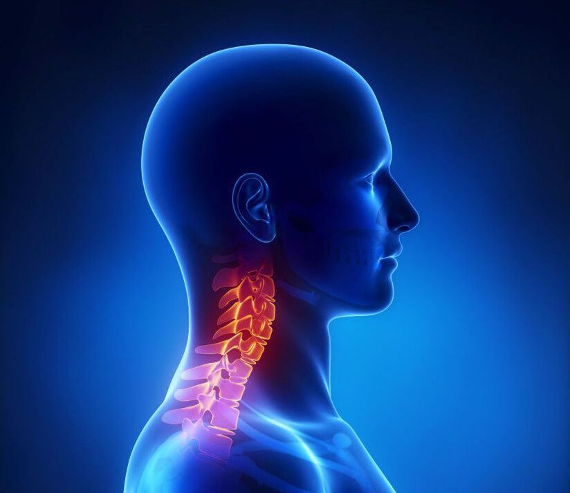Gimdos kaklelio osteochondrozė yra stuburo patologija, kurios galite atsikratyti namuose