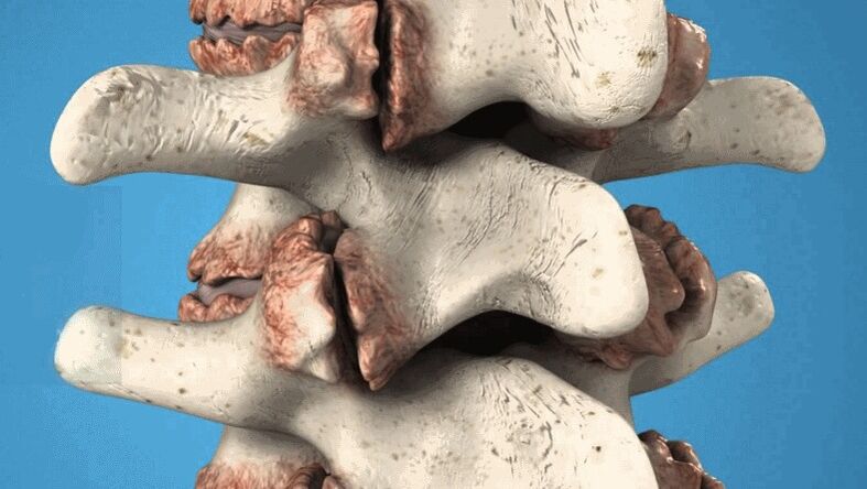 stuburo osteofitai kaip apatinės nugaros dalies skausmo priežastis