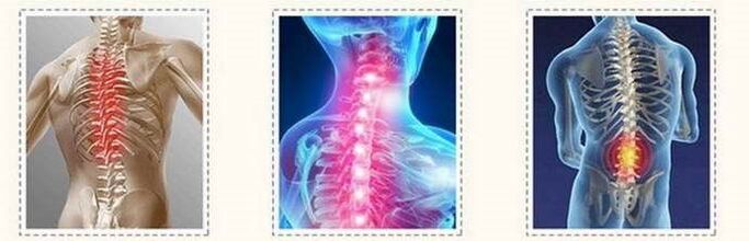 Osteochondrozės stuburo pažeidimai